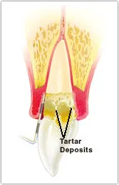 Diagram of a tooth with moderate to advanced periodontitis