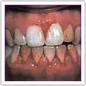 Example of bleeding gums