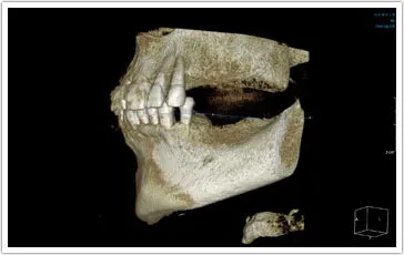 ct scan of teeth