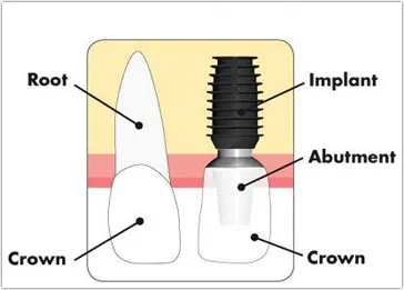Diagram comparing a natural tooth to a dental implant