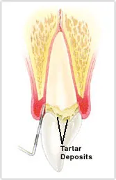 Diagram of a tooth with mild periodontitis