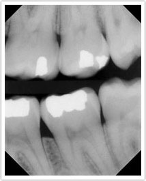 x-ray of teeth