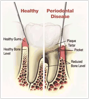 Diagram comparing a healthy tooth to a tooth with periodontal disease