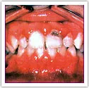Example of puffy gums