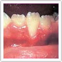 Example of gum recession