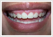 Patient's gummy smile