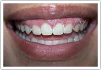 Patient's gummy smile with lines outlining the boundaries of the tooth area after crown lengthening