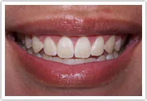 Patient's smile after crown lengthening