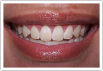Patient's smile after crown lengthening