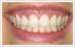 Patient's smile after crown lengthening