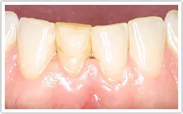Patient's teeth and gums after crown lengthening