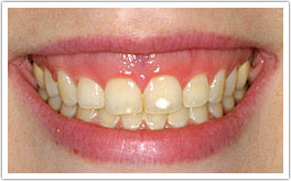 Patient's smile before crown lengthening