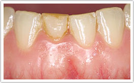 Patient's teeth and gums before crown lengthening