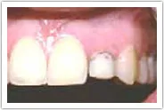 Patient's teeth and gums before crown lengthening
