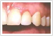 Patient's teeth and gums after crown lengthening